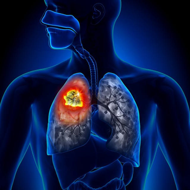 A favorable Glasgow prognostic score appears to correlate with improved overall survival and progression-free survival following treatment with atezolizumab plus carboplatin and etoposide for small cell lung cancer.