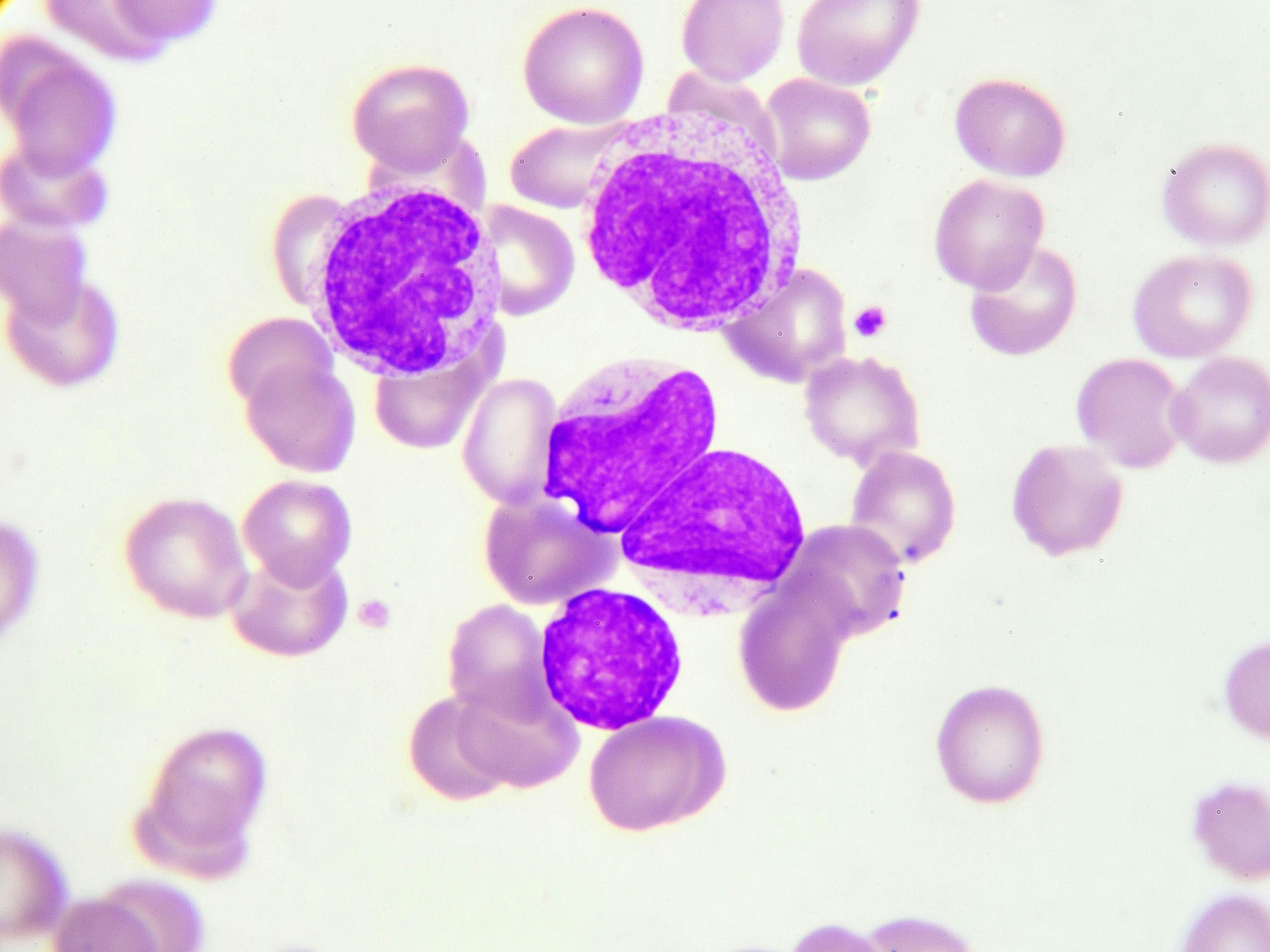 Ibrutinib Represents Possible New Treatment Option for Pretreated Hairy Cell Leukemia