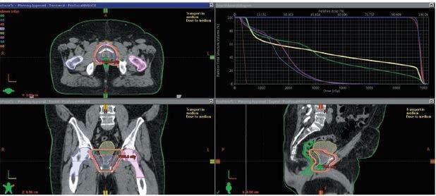 Post-Prostatectomy Radiation Therapy: Patient Selection, Timing, Imaging, and Therapy Intensification