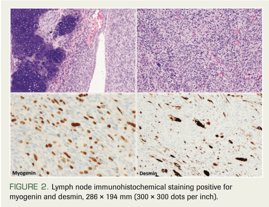 FIGURE 2. Lymph node immunohistochemical staining positive for myogenin and desmin, 286 × 194 mm (300 × 300 dots per inch).
