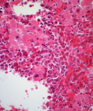 CML showing atypical lymphoid cells