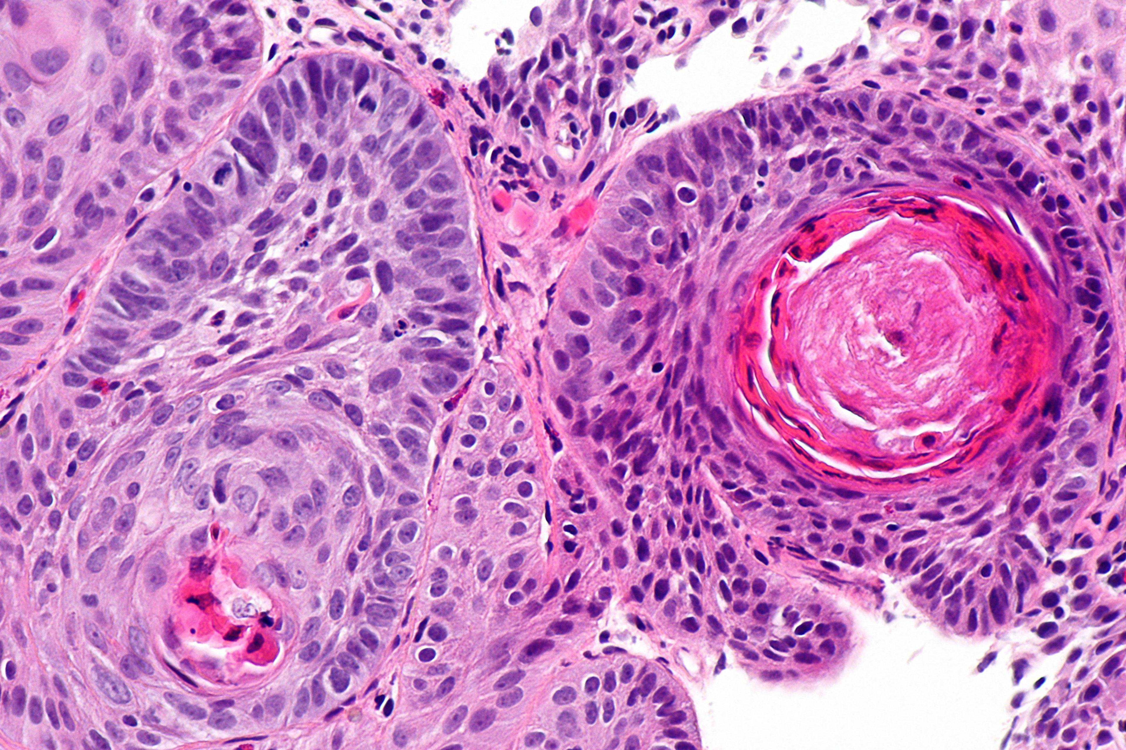 Esophageal squamous cell carcinoma