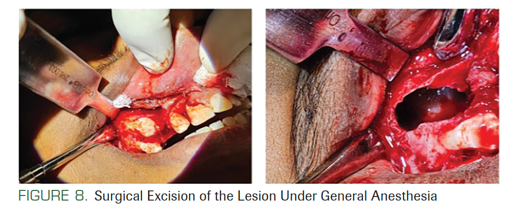 FIGURE 8. Surgical Excision of the Lesion Under General Anesthesia