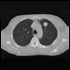 Nearly One-Fifth of Screened Lung Cancer Cases May Be Indolent