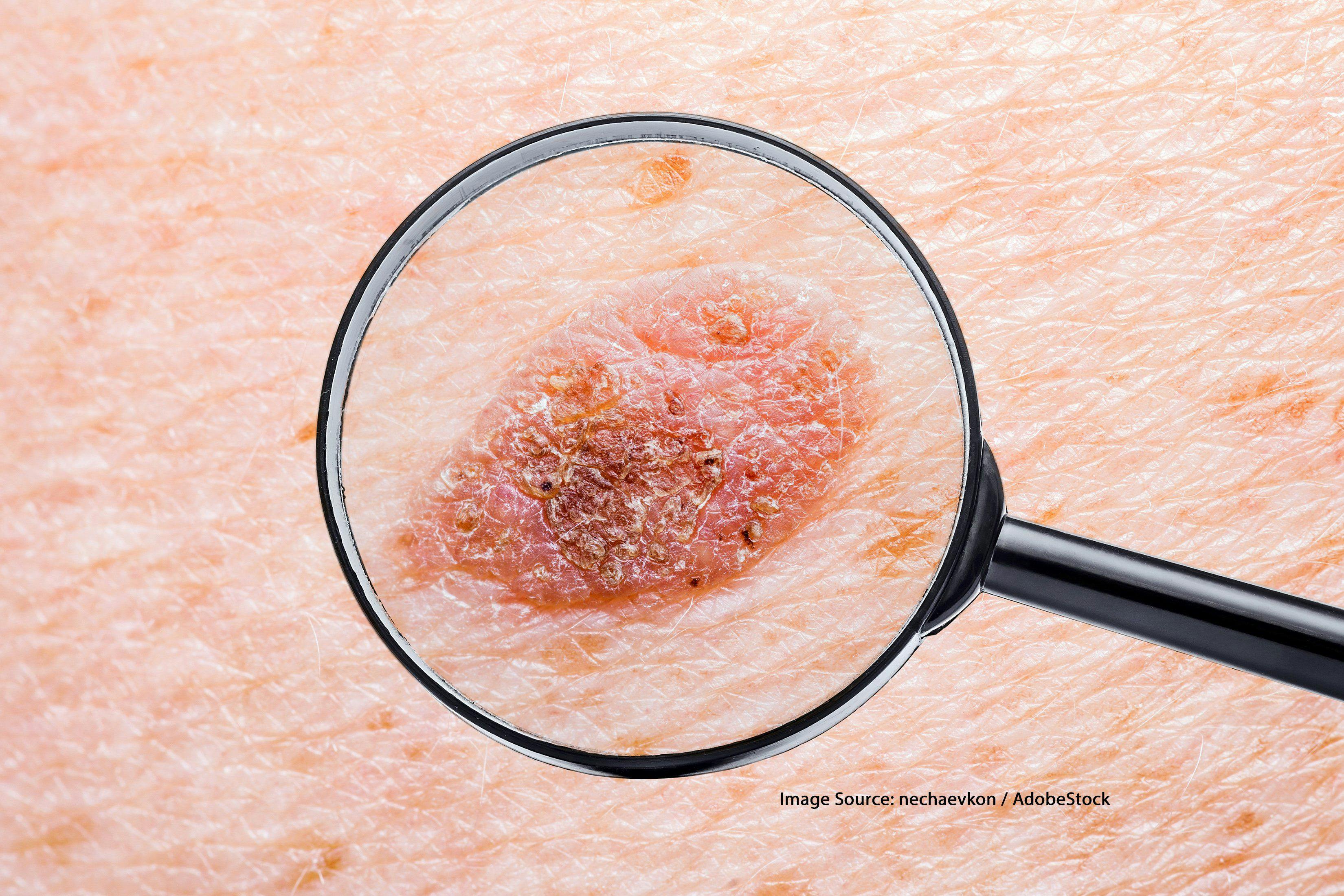 Are Thin, Early-Stage Nodular Melanomas Really Low-Risk?