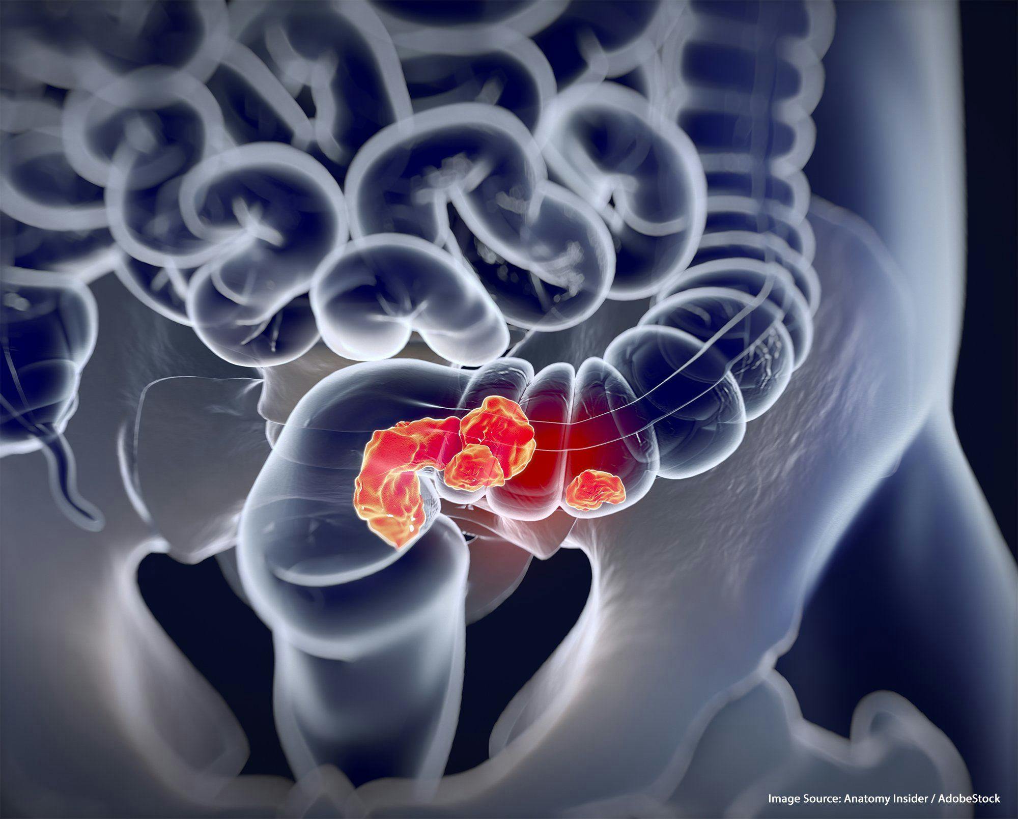 Nonoperative Management May Be Possible for Select Patients With Rectal Cancer