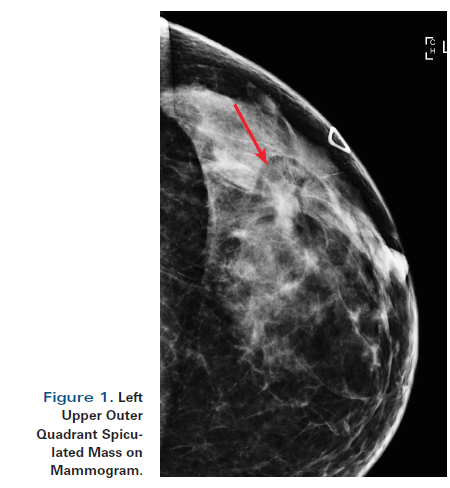 A 55-Year-Old Woman With New Triple-Negative Breast Mass, Less Than 2 cm on Both Mammogram and Ultrasound