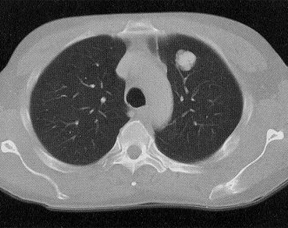 Single CT slice of a 3-cm left upper lobe adenocarcinoma of the lung