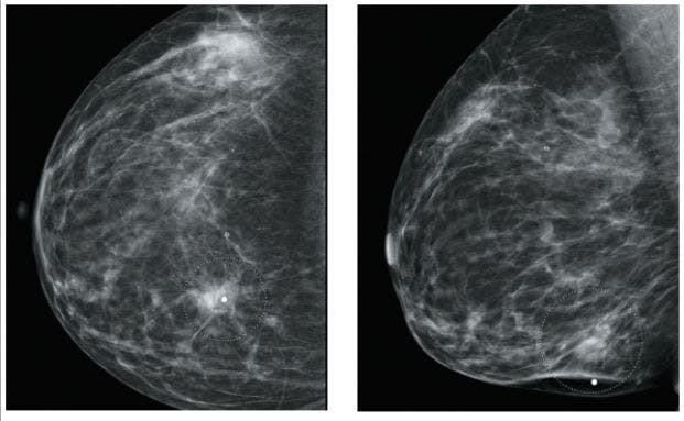 A 35-Year-Old Woman With a Change in HER2 Expression Following Neoadjuvant Chemotherapy for Invasive Breast Cancer