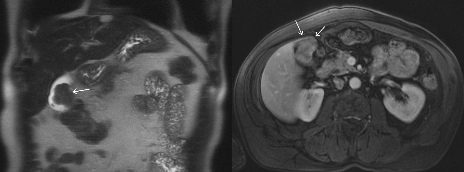 Right Upper Quadrant Pain in Abdomen of 60-Year-Old Patient