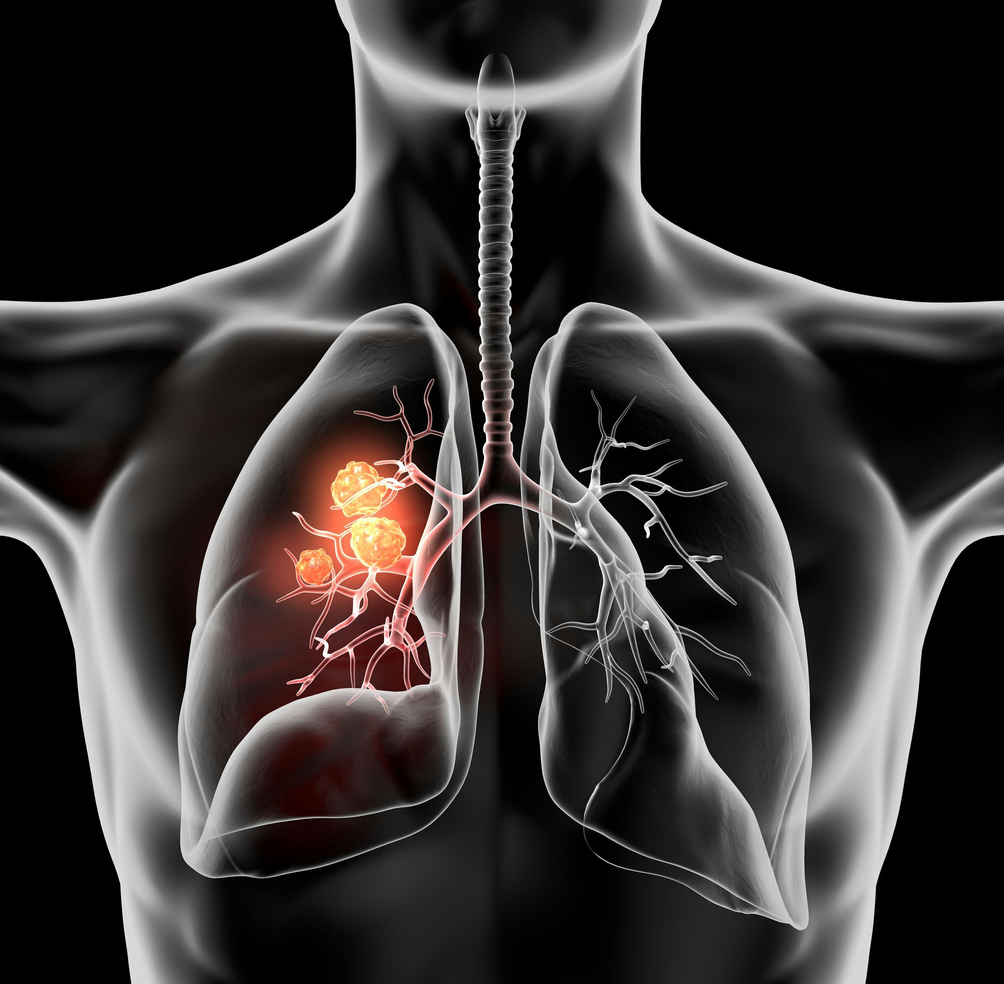 ctDNA Reductions Associated With Improved Clinical Outcomes in NSCLC Treated With IO