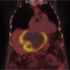 A Newly Discovered Liver Mass in a 65-Year-Old Woman