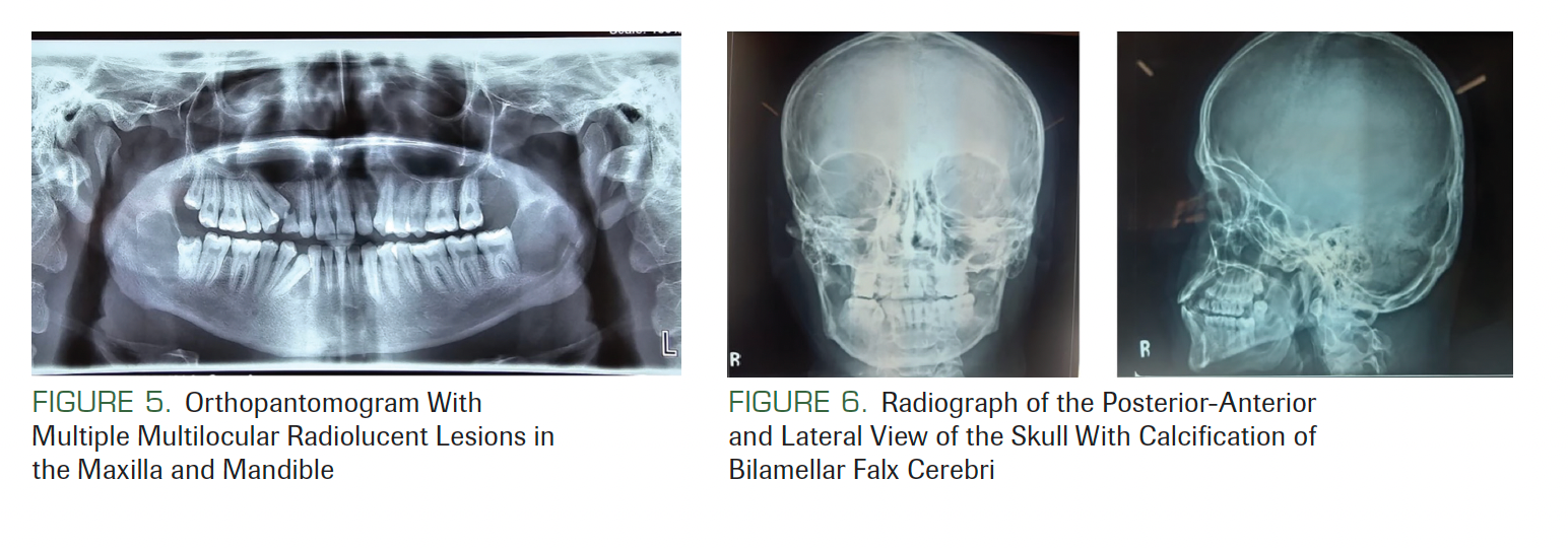 FIGURE 5. Orthopantomogram With Multiple Multilocular Radiolucent Lesions in the Maxilla and Mandible

FIGURE 6. Radiograph of the Posterior-Anterior and Lateral View of the Skull With Calcification of Bilamellar Falx Cerebri