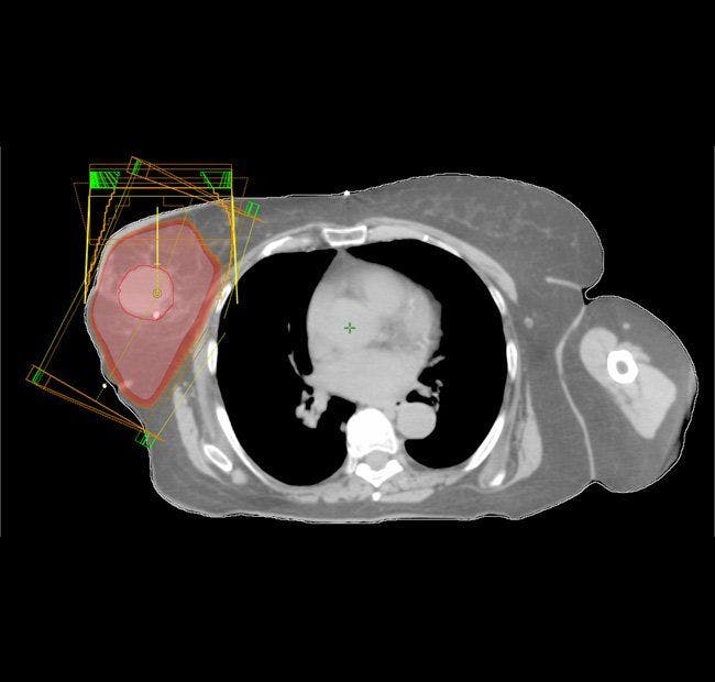 An 82-year-old patient treated with accelerated partial-breast irradiation