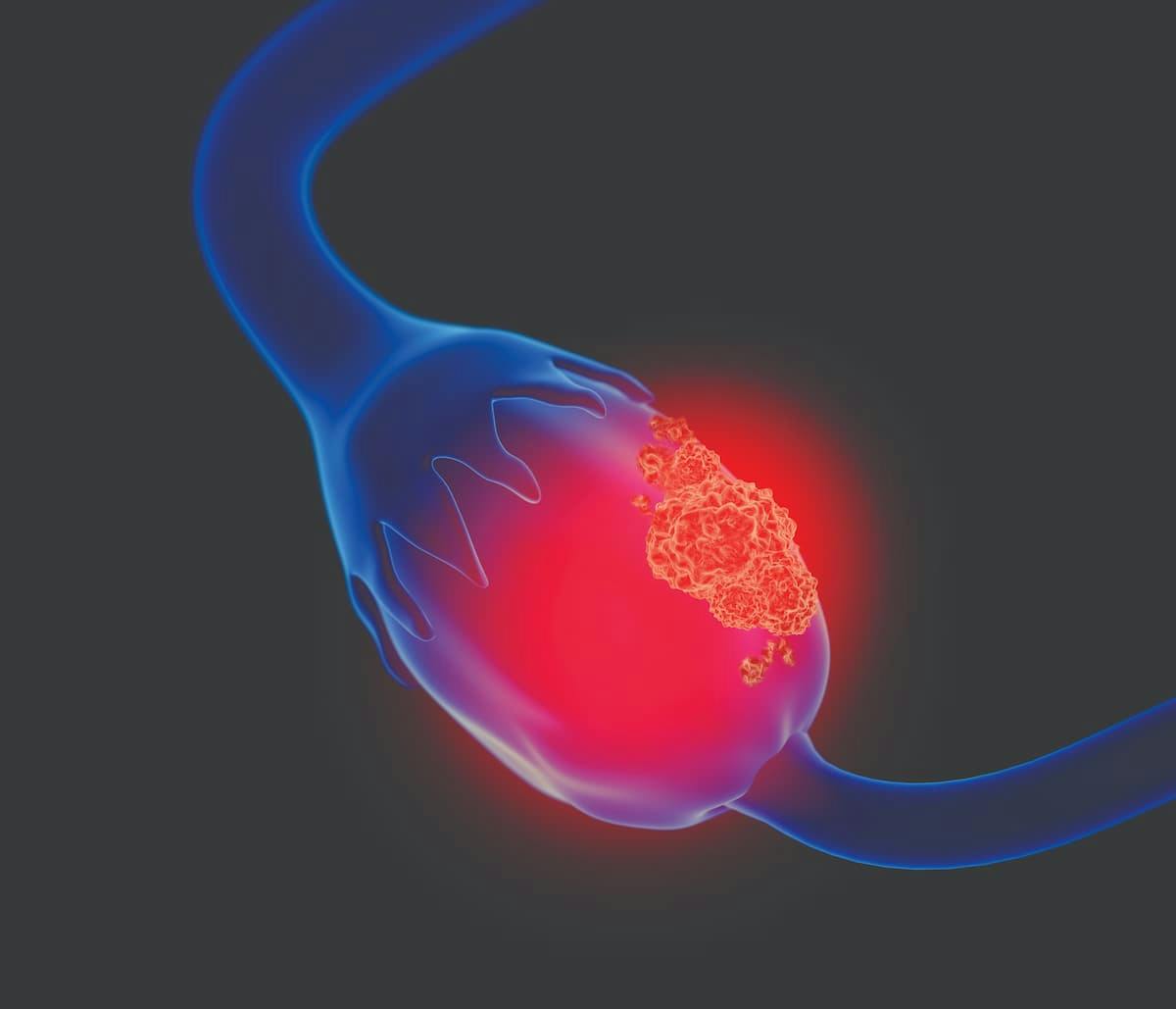 The VENTANA FOLR1 RxDx Assay has received approval from the FDA for identifying epithelial ovarian cancer in patients who may be eligible for treatment with mirvetuximab soravtansine-gynx.