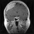 Primary and Metastatic Brain Tumors