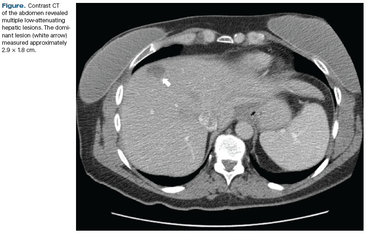 Multiple Hepatic Lesions in a Patient With a History of DCIS