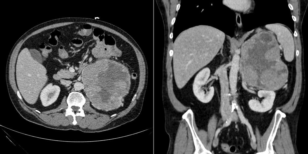 Abdominal Fullness in a 56-Year-Old Woman