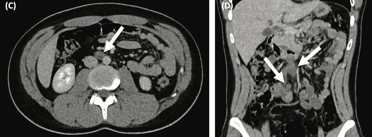 (C, D) Follow-up axial and coronal CT scans after 4 cycles of bleomycin, etoposide, and cisplatin (BEP) show a partial response to systemic therapy with a residual retroperitoneal disease of 1.64 cm (arrow).


