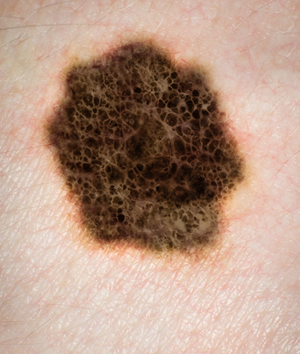 Large melanoma