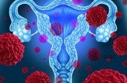 Mirvetuximab Soravtansine Combination Yields Encouraging Response Rates in Ovarian Cancer