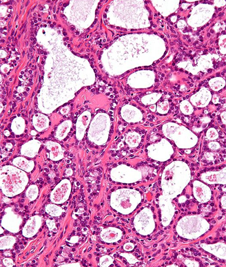 Micrograph of an ovarian clear cell carcinoma