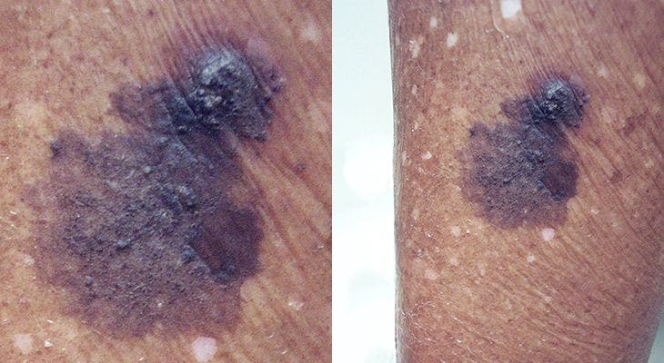 A 67-Year-Old African American Woman Presents With a Lesion on the Right Leg