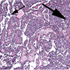 Collision Renal Cell Papillary and Medullary Carcinoma in a 66-Year-Old Man