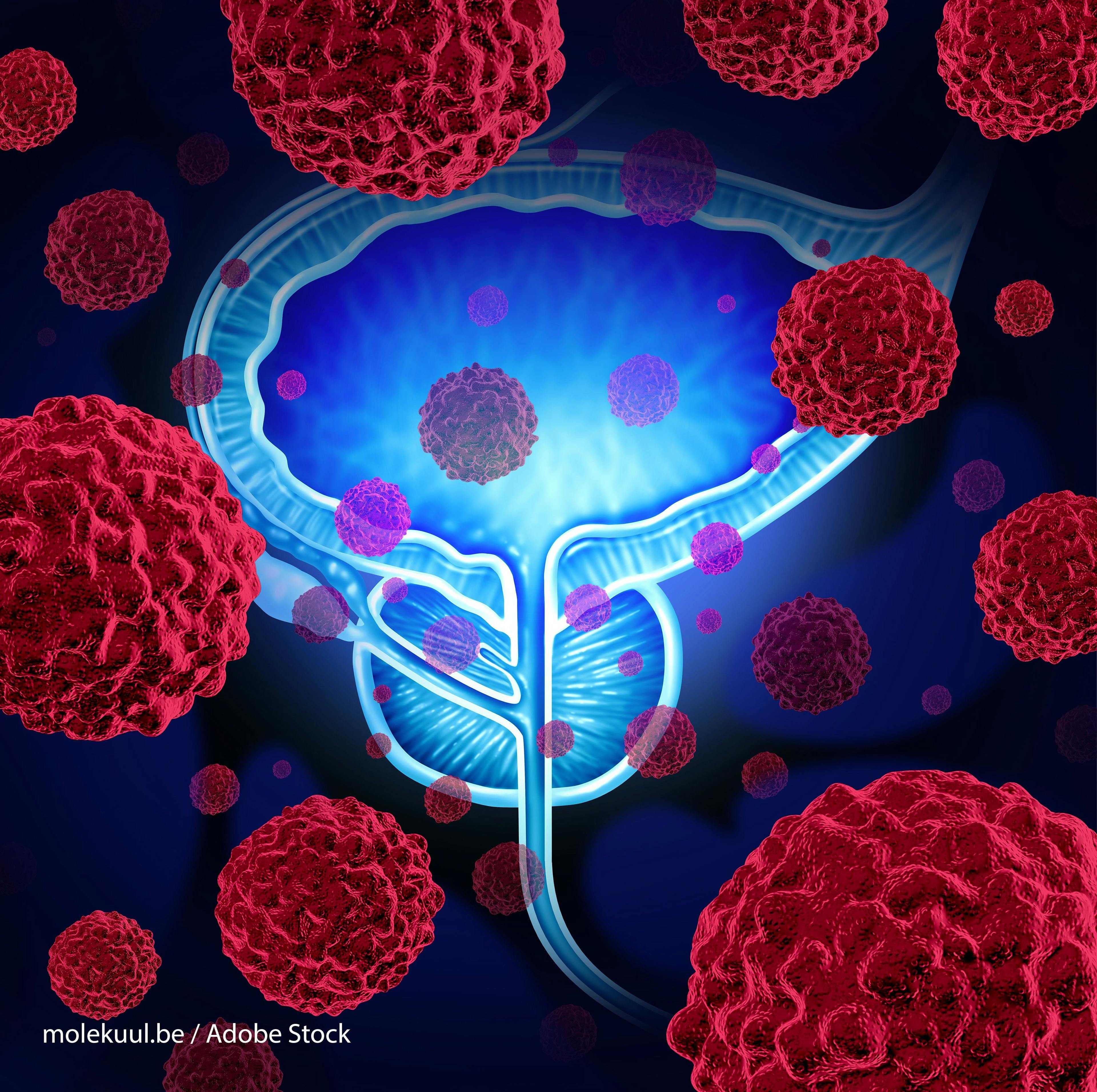 Updated Trial for PSMA-Targeted Therapy in Metastatic Prostate Cancer Excites