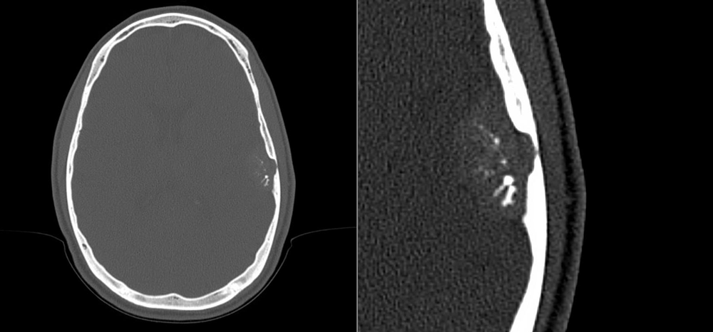 Brain CT Scan Shows “Spoke Wheel” Pattern Following Concussion
