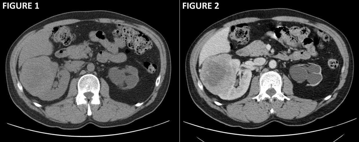 Hematuria and Abdominal Pain in a 50-Year-Old Man