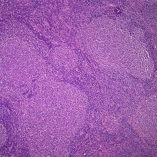 48-Year-Old Man Presents With Diffuse Lymphadenopathy