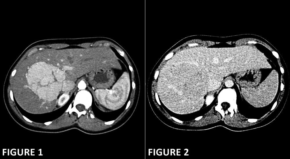 Liver Abnormality in 28-Year-Old Patient
