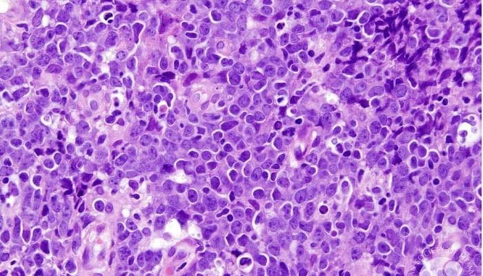 Investigators have launched a first-in-human phase 1 trial (NCT06132503) that will evaluate LP-284 as a treatment for those with B-cell non-Hodgkin lymphoma, including patients with high-grade B-cell lymphoma and mantle cell lymphoma (MCL).
