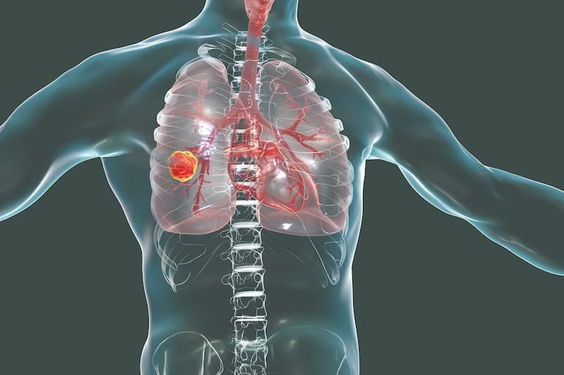 Substantial OS Improvement Seen With Atezolizumab in Platinum-Ineligible NSCLC