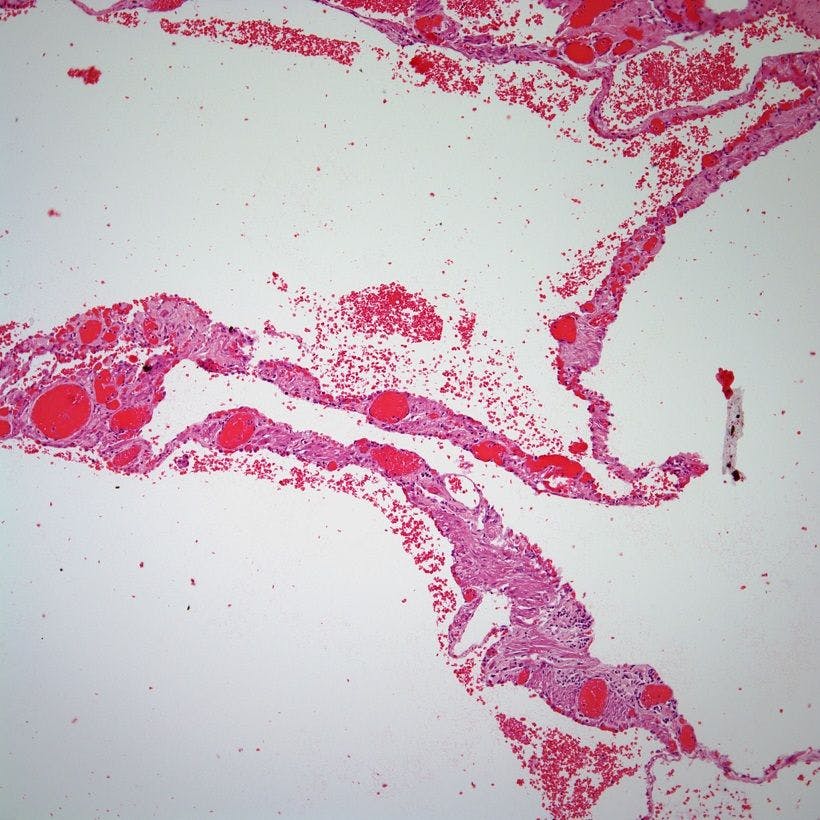 A 38-Year-Old Woman With Dyspnea and General Malaise