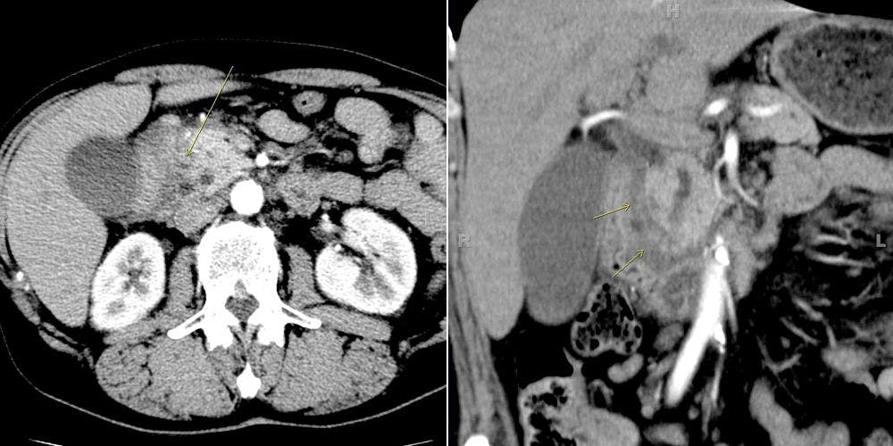 Abdominal Pain in Patient With History of Heavy Alcohol Use