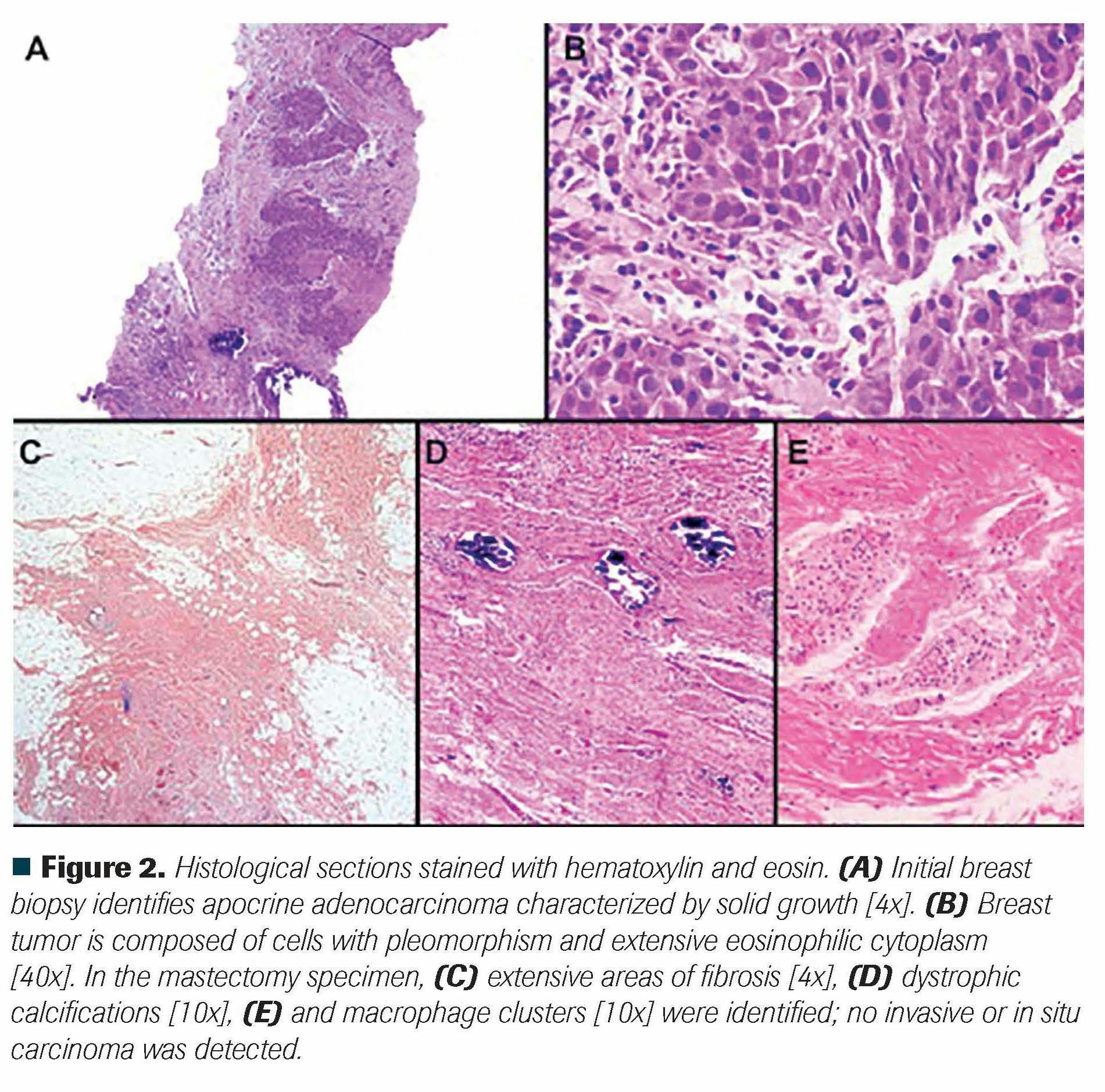 Figure 2. Histological sections stained with hematoxylin and eosin. (A) Initial breast biopsy identifies apocrine adenocarcinoma characterized by solid growth [4x]. (B) Breast tumor is composed of cells with pleomorphism and extensive eosinophilic cytoplasm [40x]. In the mastectomy specimen, (C) extensive areas of fibrosis [4x], (D) dystrophic calcifications [10x], (E) and macrophage clusters [10x] were identified; no invasive or in situ carcinoma was detected.