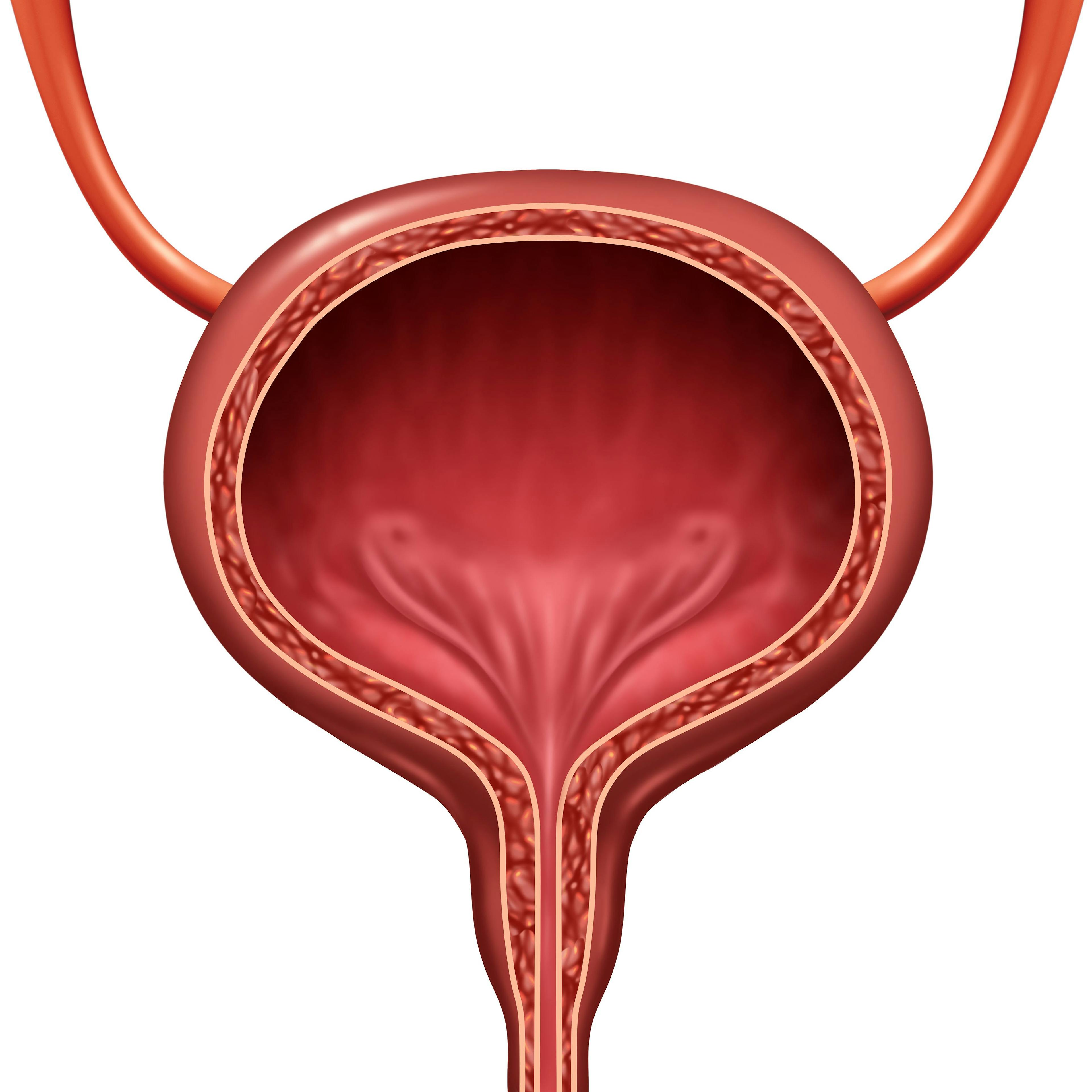 Patients with Bacillus-Calmette Guérin (BCG)–unresponsive non–muscle invasive bladder cancer experienced promising responses to treatment with of durvalumab and Vicineum, which was also well tolerated.
