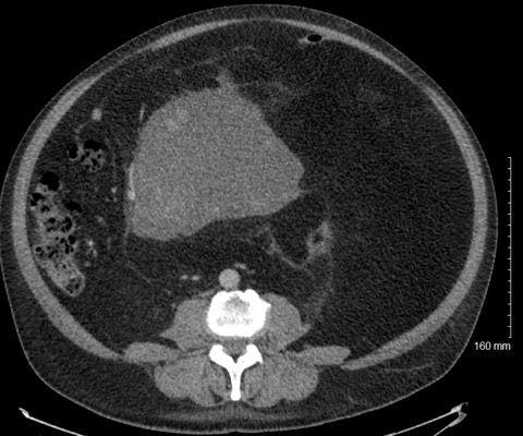 A 51-Year-Old Male With Abdominal Distention, Pain, and A Retroperitoneal Mass