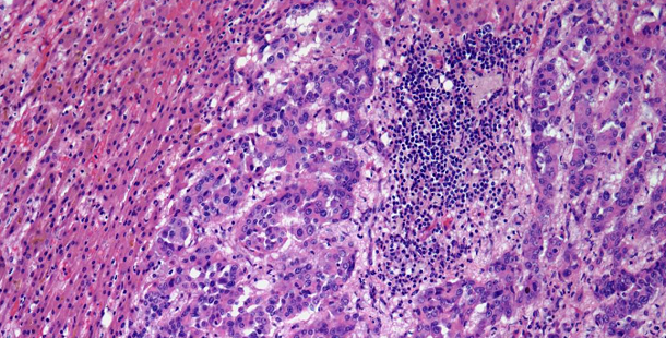Large Liver Mass Found in 53-Year-Old Man