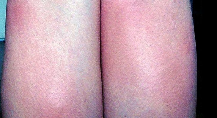 A 58-Year-Old Woman on Gemcitabine Developed Swelling and Erythema of Both Legs