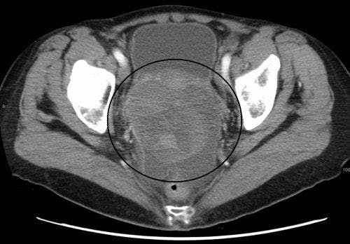 Ovarian cancer as seen on CT