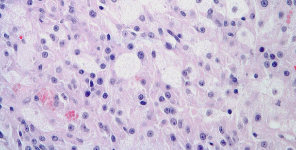 Testicular Lesion Detected in 23-Year-Old Man