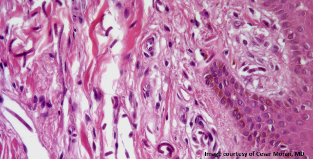 Right Arm Skin Lesion Found in 47-Year-Old Man