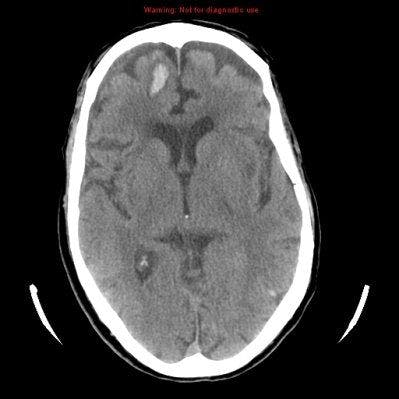 Total Resection Associated With Better Survival in Atypical, Malignant Meningioma
