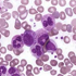 Peripheral Blood Showing Markedly Increased WBC