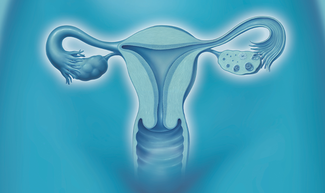 Power morcellation, uterine cancer link