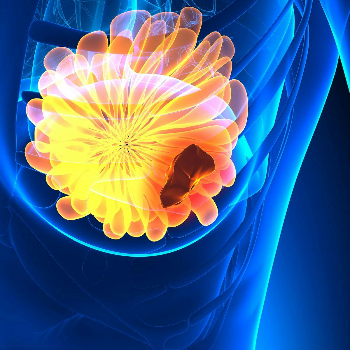 Findings from the SqeDCIS trial indicated that DCISionRT was predictive of radiotherapy benefit in patients with ductal carcinoma in situ of the breast.