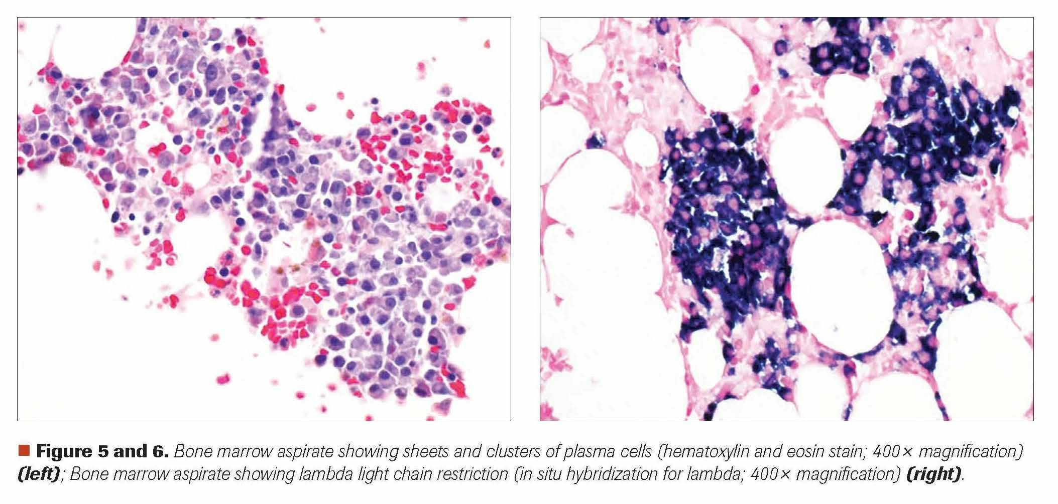 Figure 5 and 6. Bone marrow aspirate showing sheets and clusters of plasma cells (hematoxylin and eosin stain; 400x magnification) (left); Bone marrow aspirate showing lambda light chain restriction (in situ hybridization for lambda; 400x magnification) (right).